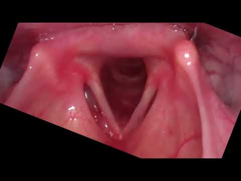 Vocal cord motion during breathing