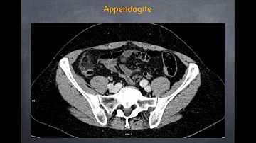 Quel est le diagnostic différentiel de la crise appendiculaire ?