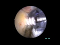 Arthroscopic Subscapularis Repair - Randy Schwartzberg, M.D.