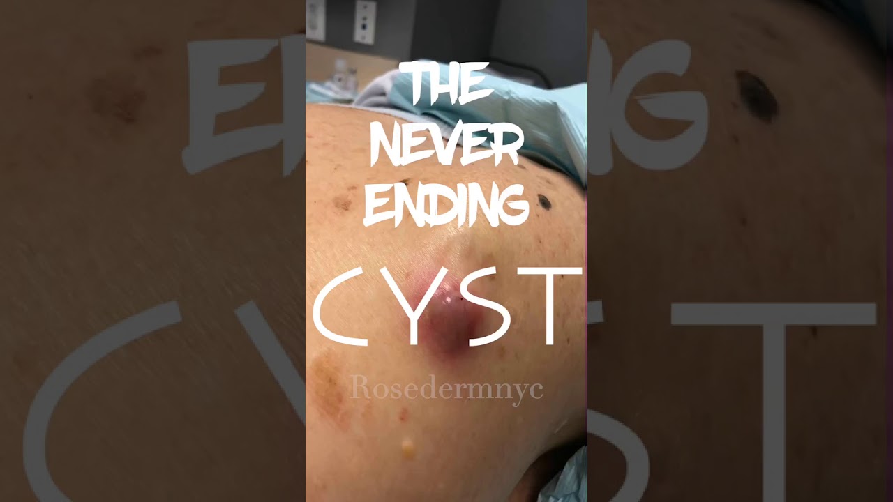 Idaho Potato Cyst