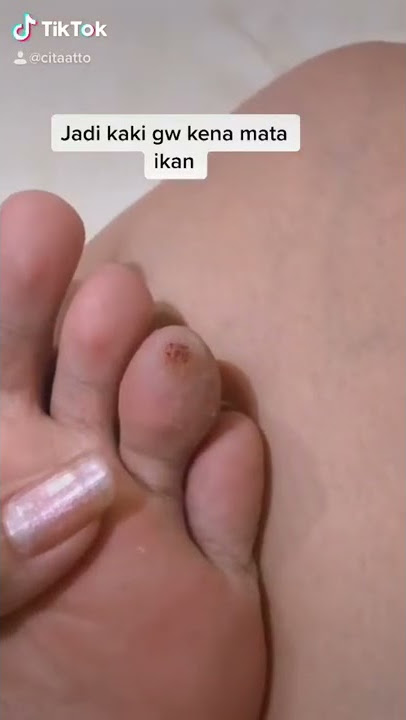 Cara mengobati mata ikan ala bapak cunwan