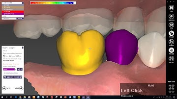 case2 #5  design Screw type crown by using stock abutment scan