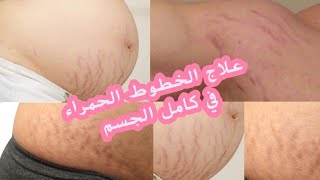 تخلصي من الخطوط الحمراء في الجسم للأبد تجربتي الشخصية في القضاء على الخطوط الحمراء