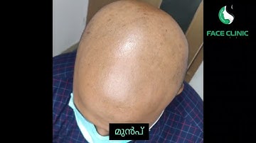 complete solution for baldness,scalp micro pigmentation before and after.#scalpmicropigmentation