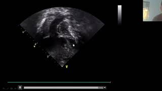 Approach to Cyanotic Heart Disease 20190627 0247 1