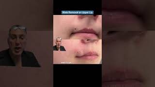 Mole Removal on Upper Lip