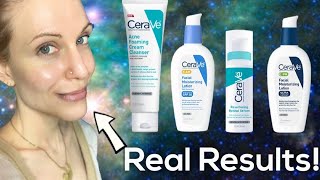 I Tried CeraVe's Acne Skin Care Routine