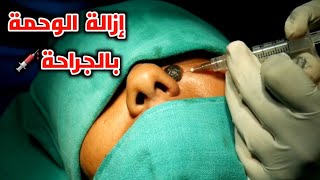 شاهد كيف يتم ازالة الوحمة بالجراحة_Surgical removal of birthmarks