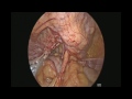 Laparoscopic pectopexy for vault prolapse dr  akhil saxena