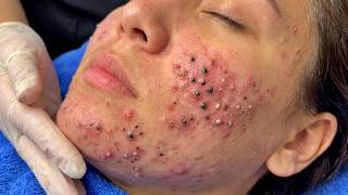 Blackhead Removal With Today Spa #2653