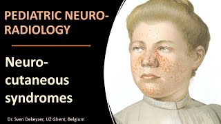 Imaging of Neurocutaneous Syndromes