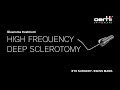 Spotlight hfds high frequency deep sclerotomy  glaucoma treatment