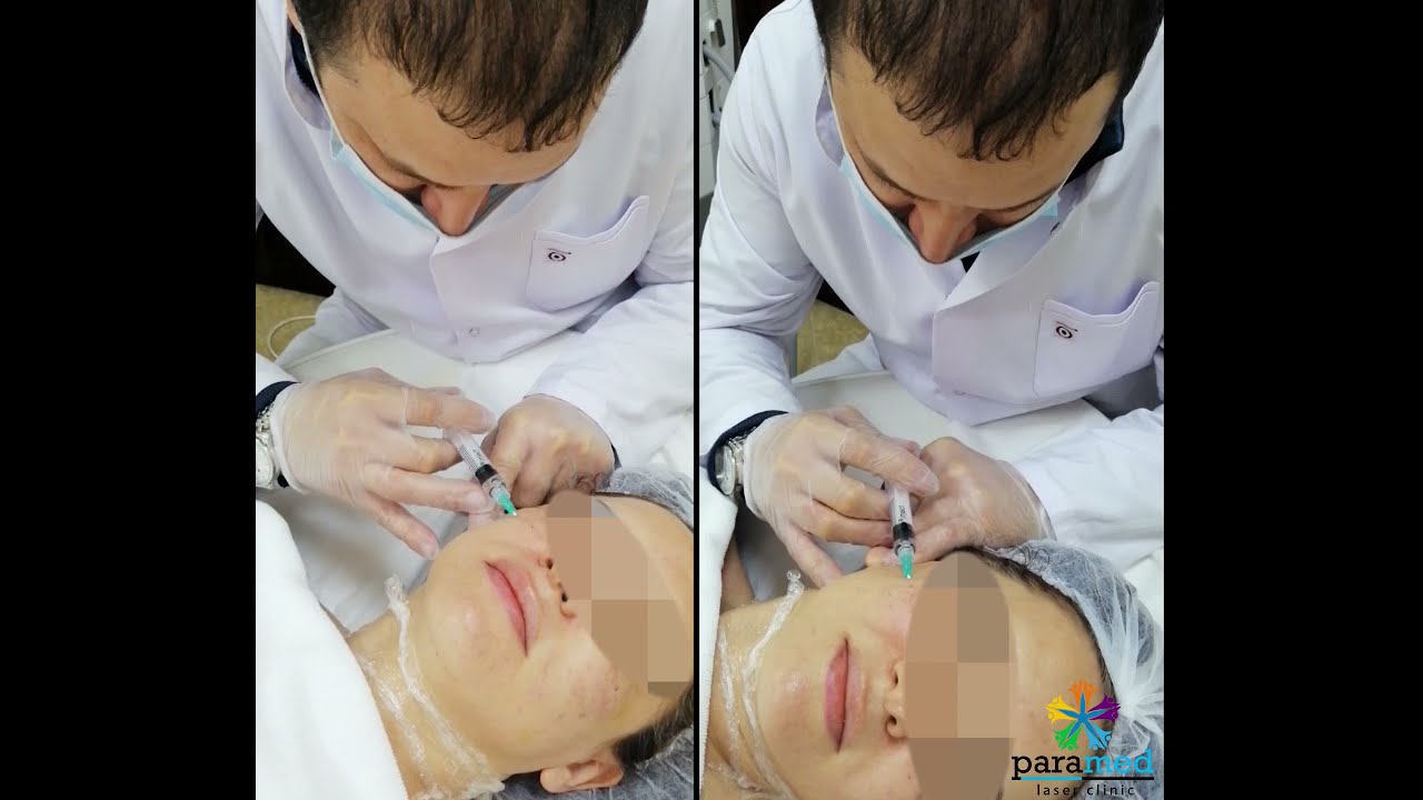Dərinin biorevitalizasiyası