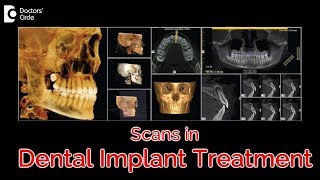 Role of CBCT scans in Dental Implant Treatment  Dr. Deepa Jayashankar|Doctors' Circle