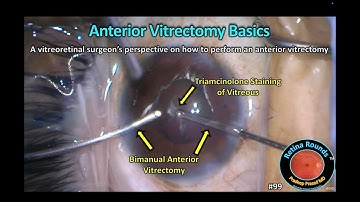 RetinaRounds™ 99: Anterior Vitrectomy Basics