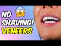 No shaving emax veneers  my veneer smile dental clinic