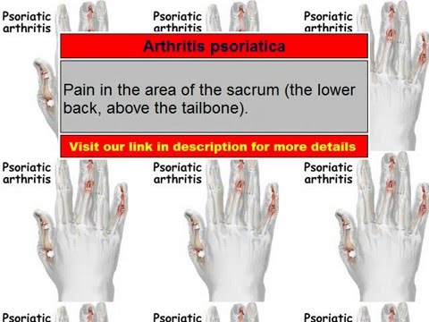 arthritis psoriatica osteoarthritis 1 szakaszában hogyan kell kezelni