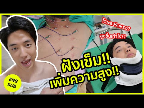 ฝังเข็ม-ยืดตัวเพิ่มความสูงครั้งแรก!! สูงขึ้น 4-5cm!! อายุเยอะก็สูงได้?! | KAYAVINE