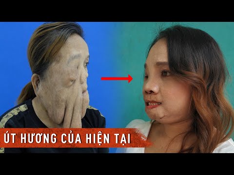 Video: Ở OKB Số 2 ở Tyumenka, Phẫu Thuật Thẩm Mỹ được Thực Hiện Sau Khi Cắt Bỏ Khối U