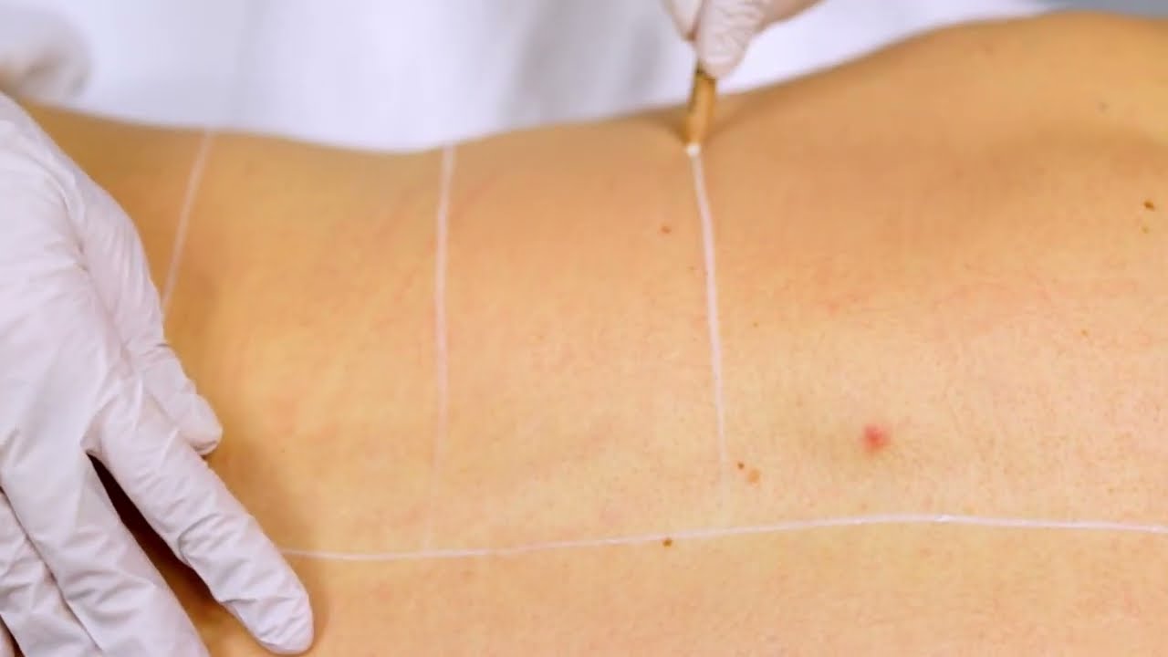 Laserbehandeling ontharen 