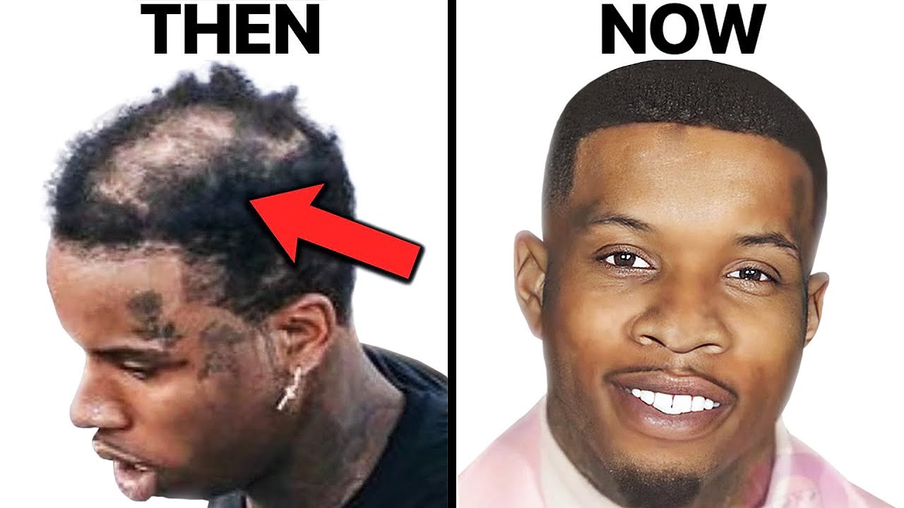 Tory Lanez NEW HAIR | Hair Surgeon Reacts