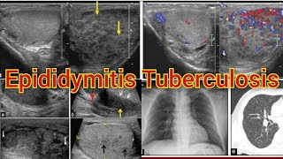 Radiology Viva Case # 02 | Epididymitis Tuberculosis | Disseminated Tuberculosis #medical #radiology