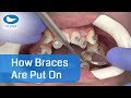 How braces are put on - AMAZING ! - Now with 12 month - Progress : https://goo.gl/jXaY15