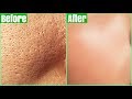 How To Get Rid Of LARGE PORES PERMANENTLY (100% Works)| Shrink & Get Clear Glass Skin Naturally