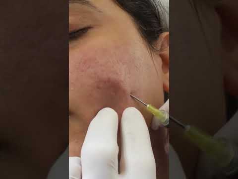Video: Kunne fugtighedscreme forårsage acne?