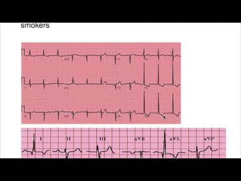 lvh,-rvh-(left-ventricular-&-right-ventricular-hypertrophy)-ekg-criteria