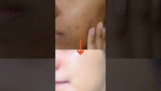 Treat dark spots, pigmentation, acne scars   Fast ?Turmeric Face Serum ashortaday