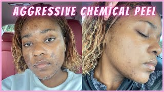 I GOT A CHEMICAL PEEL! | BEFORE/AFTER ACNE SCARS