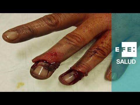 Vídeo: Dedo Cortado: Primeros Auxilios, Cirugía Y Recuperación