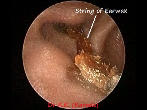 otoendoscopic earwax removal string sheet of earwax cleaning otoendoscopic earwax removal string sheet of earwax cleaning