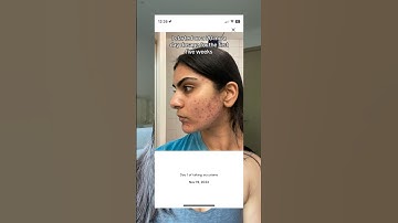 I tracked my accutane transformation on my app “Clear skincare” #acne #accutane #skincare
