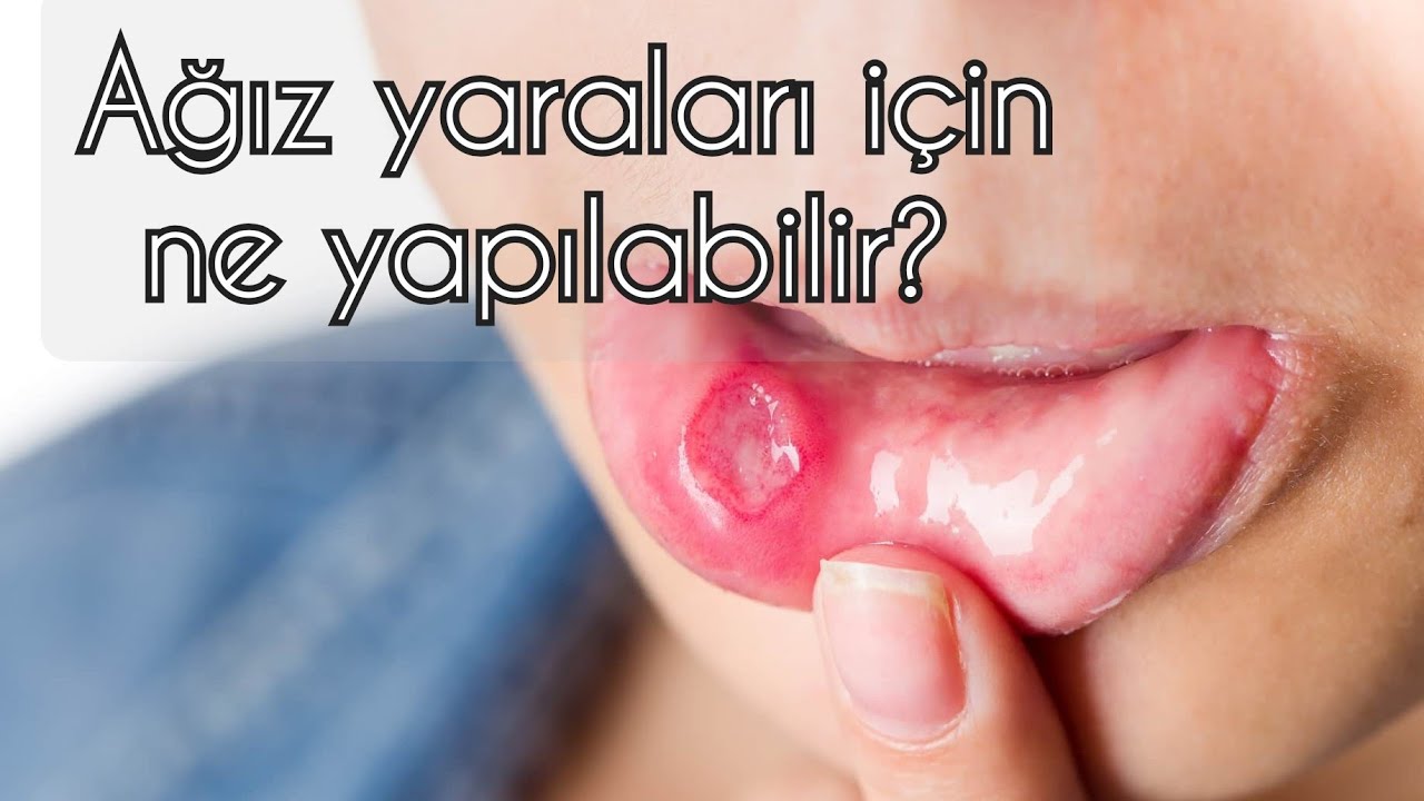 Aftlar, ağız yaraları sebepleri ve tedavi yöntemleri. Canker sores, diagnose and treatment.