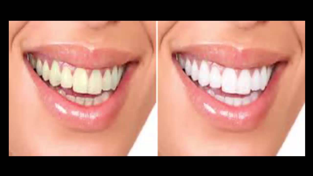 Smartly Apply Teeth Whitening Technics