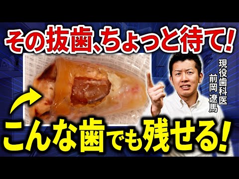 【衝撃の事実】抜歯宣告を受けた歯も残せる!【実例解説あり】