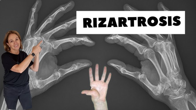 Rizartrosis o artrosis del pulgar. Síntomas, tratamiento y