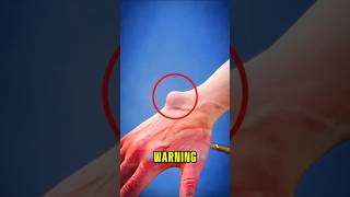 DON'T Smash This Hand Lump! The Truth About Ganglion Cysts