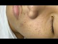 Blackhead, Acne P2 (Nghia) | Mụn Đầu Đen, Mụn Trứng Cá P2 (Nghĩa) - SacDepSpa#332