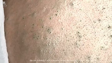 Big Cystic Acne Blackheads Extraction Blackheads & Milia, Whiteheads Removal Pimple Popping