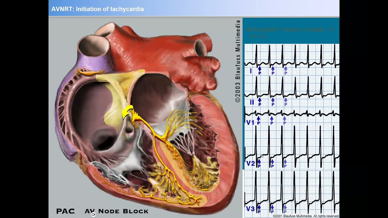 Ep16 - Understanding Supraventricular Tachycardias - SVTs - Dr. Theofanie Mela, Harvard/Mass General