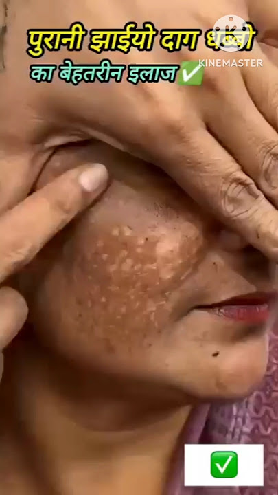 Download lagu Dark Spots & Pigmentation removal at home✨️| fair & clean skin pack|#Pigmentation #skincare #shorts👍