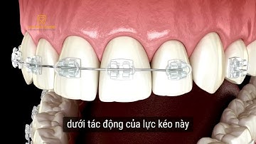 [LSS] NHA KHOA  QUY TRÌNH NIỀNG RĂNG MẮC CÀI