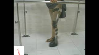 Polio woman with a legbrace and built-up shoe in rehab.