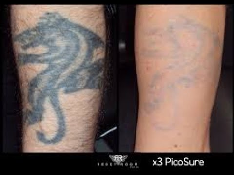 4 weeks Tattoo Removal Cream Maximum Strength Wrecking Balm Fade Skin  Moisturize 796914179313  eBay
