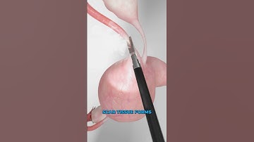 Electric Birth Control (3D Animation)