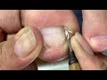 How to get deep corners of feetnail cutting techniques for hands and feet for beginners