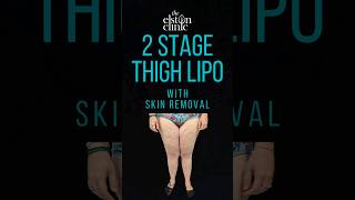 Staged liposuction and thigh lift  #transformation #lipedema